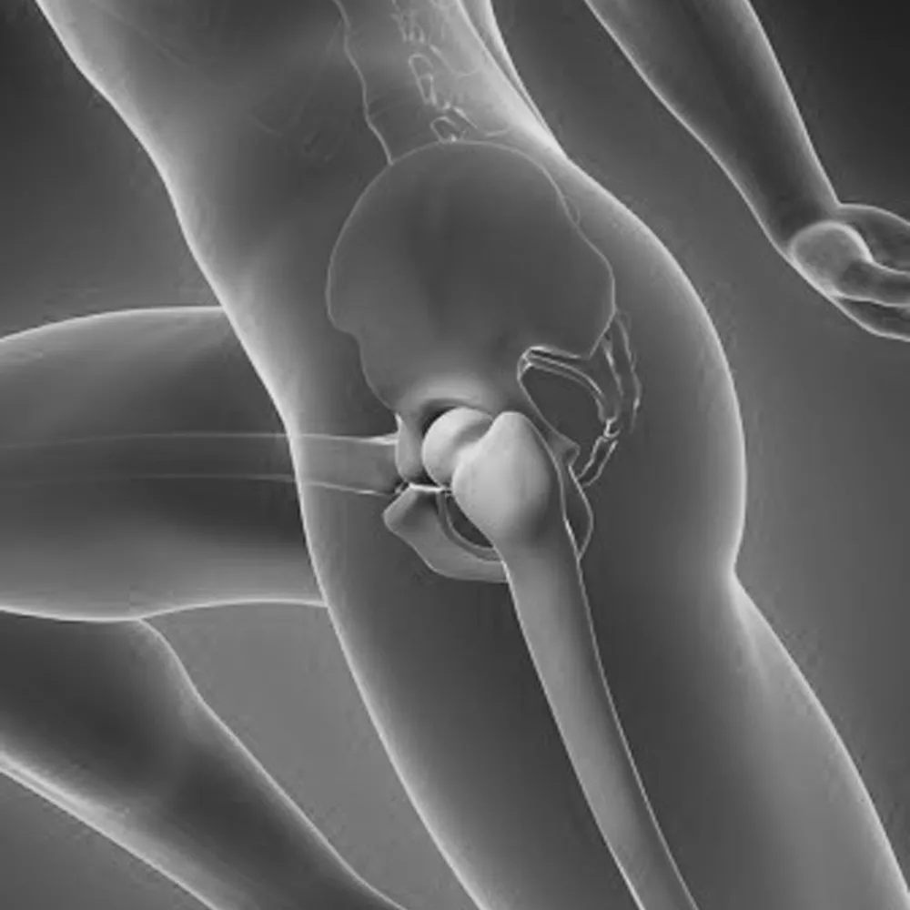 HIP INJECTION
